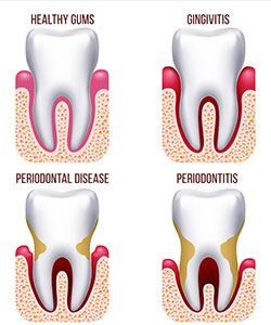 Gum Disease Main And Palmer Family Dentistry Garden City Ks